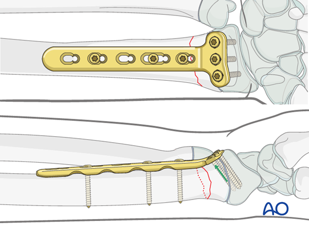open reduction plate fixation