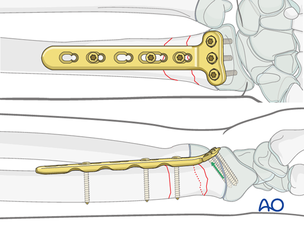 open reduction plate fixation