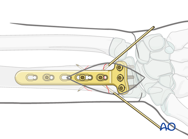 open reduction plate fixation