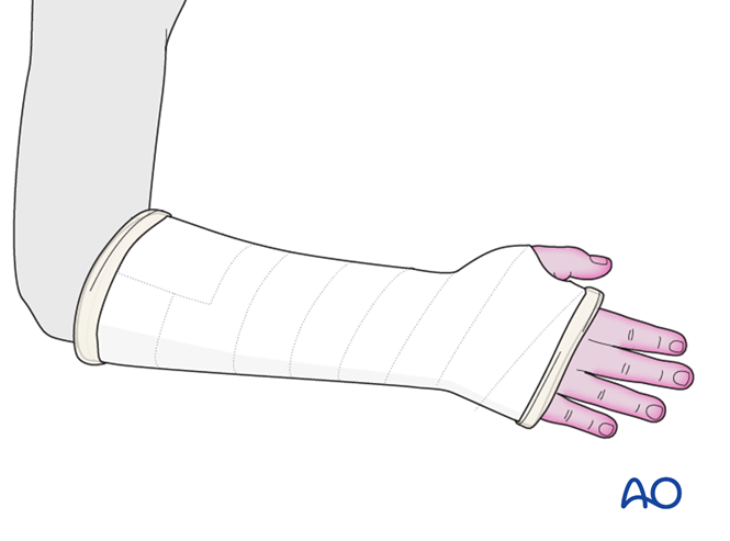 Open reduction; K-wire fixation for Avulsion of the styloid, ulna