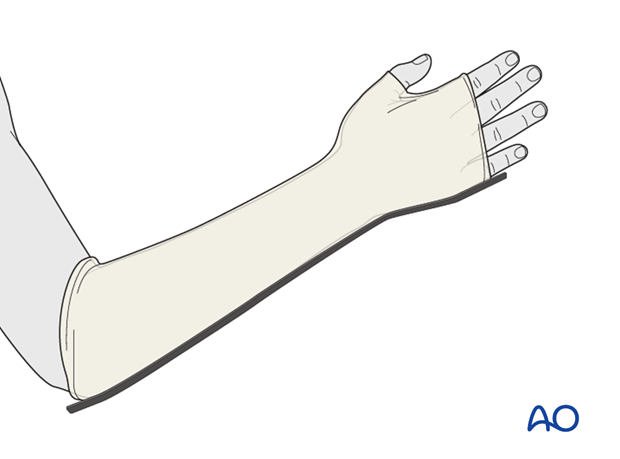 short arm cast