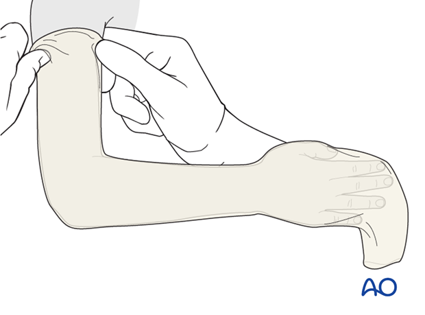 long arm cast