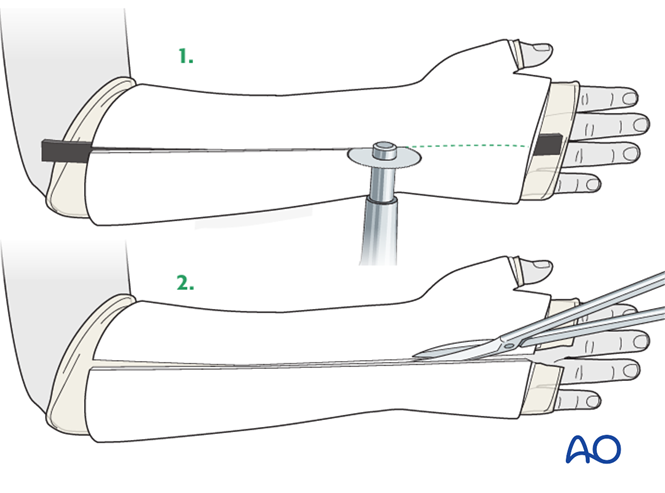 Open reduction; K-wire fixation for Simple epiphysiolysis with ...