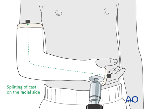 closed reduction long arm cast