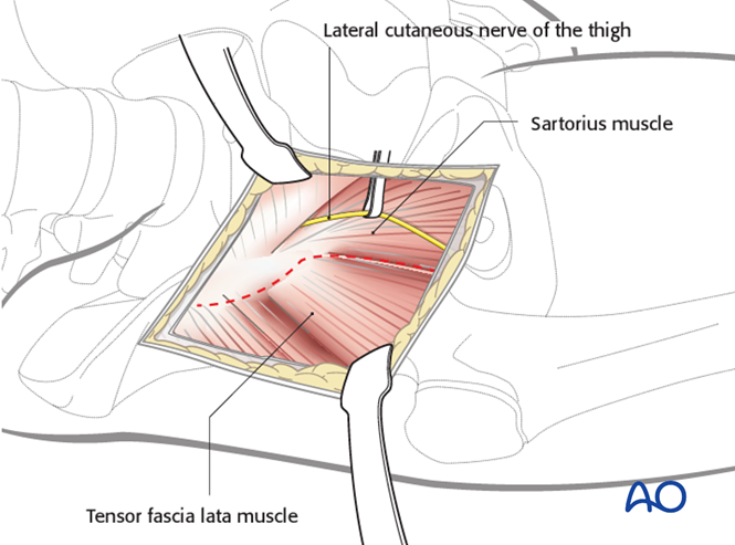 Anterior approach to the pediatric proximal femur