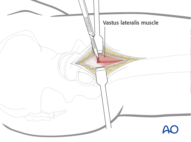 lateral approach