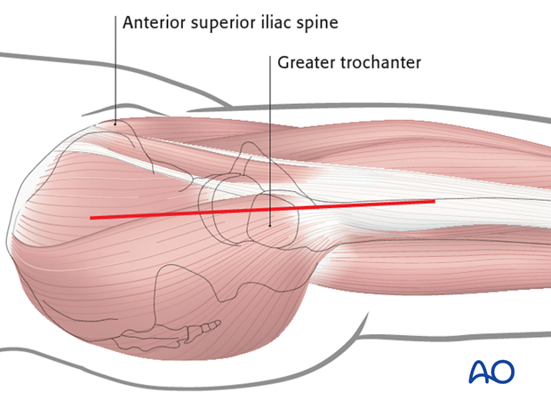 lateral approach via trochanteric flip
