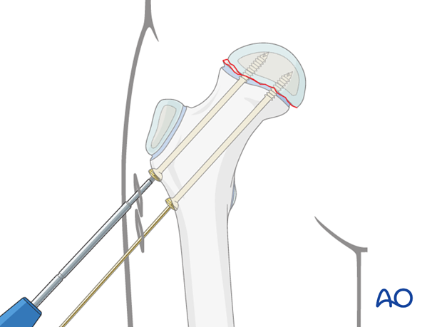 in situ fixation with k wires or screws