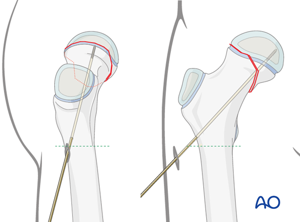 in situ fixation with k wires or screws