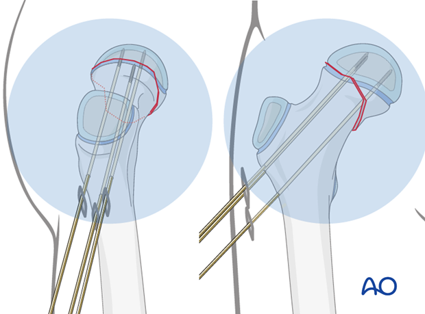 in situ fixation with k wires or screws