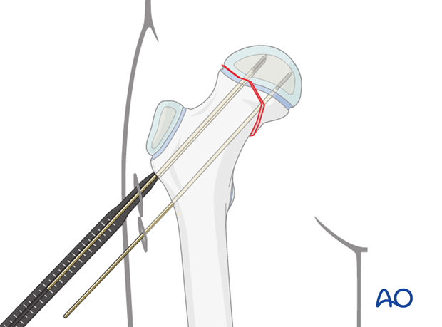 in situ fixation with k wires or screws