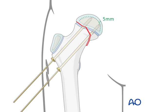in situ fixation with k wires or screws