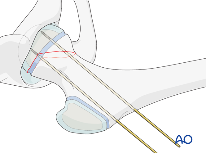 Open reduction, K-wire fixation for Epiphysiolysis with metaphyseal ...