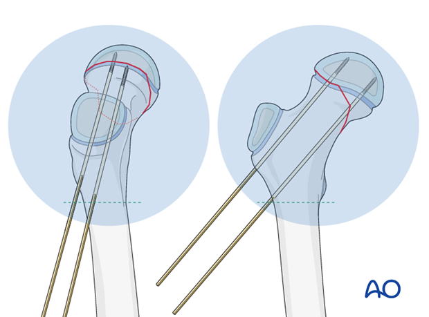 open reduction k wire fixation