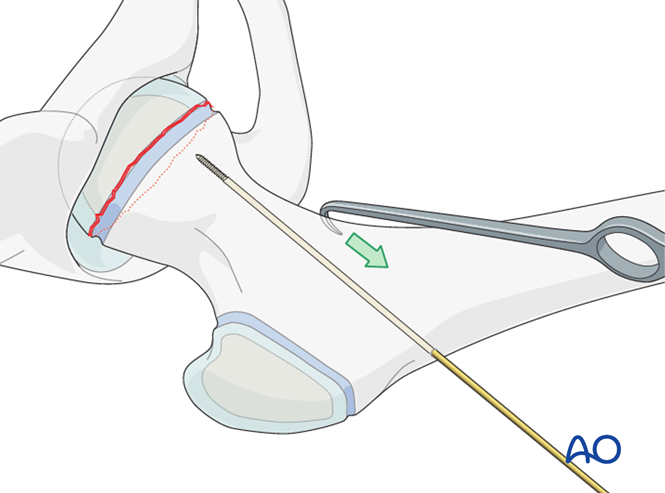 Open reduction, screw fixation for Traumatic epiphysiolysis, SH I