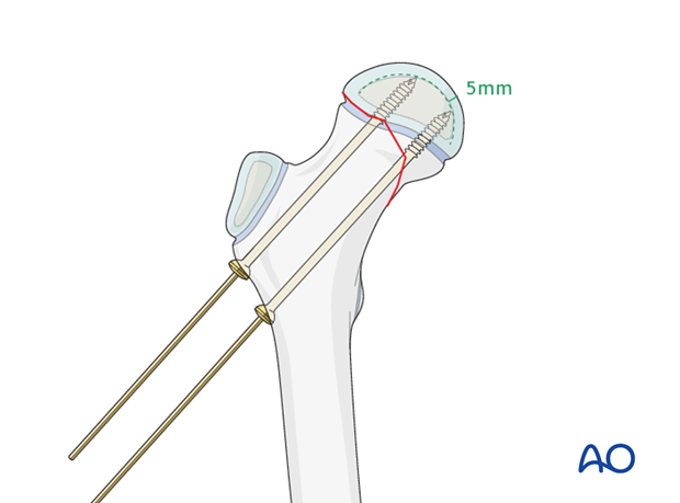 open reduction screw fixation