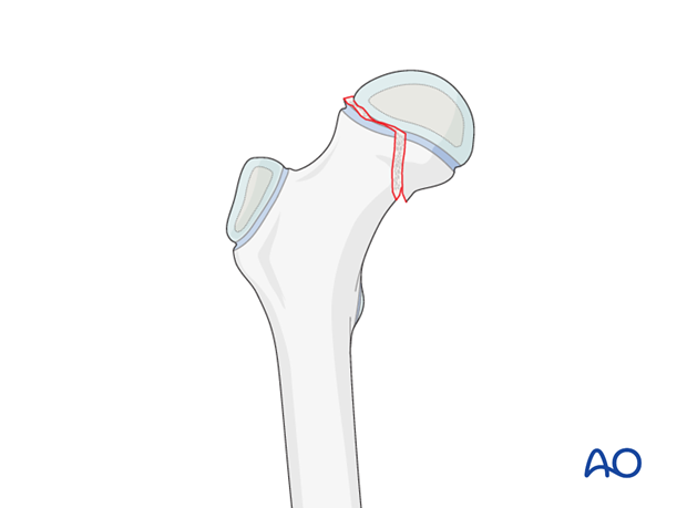 open reduction pediatric hip locking plate