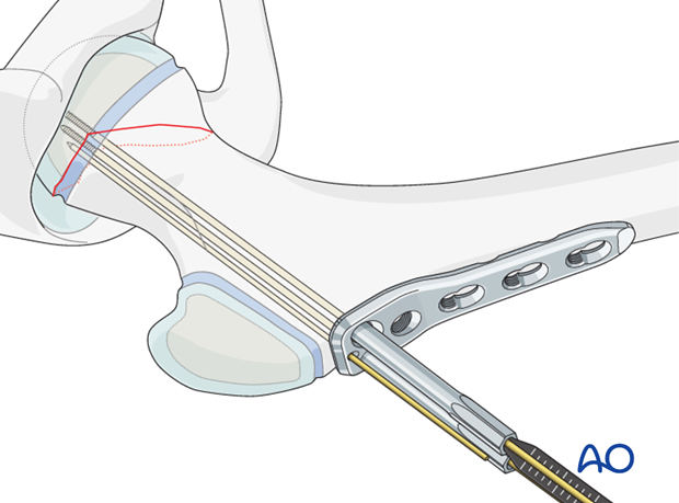 open reduction pediatric hip locking plate