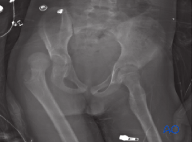 removal of osteochondral fragment