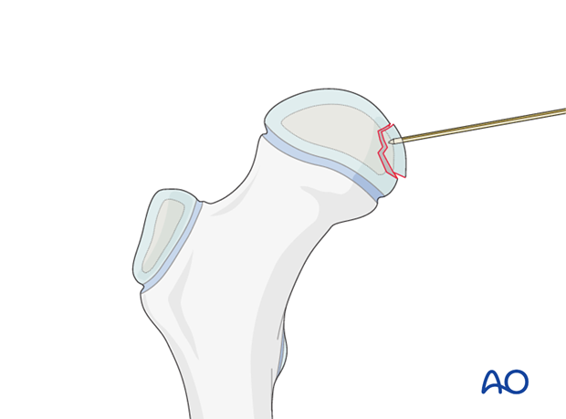 open reduction resorbable pin fixation