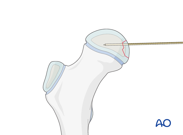 open reduction resorbable pin fixation