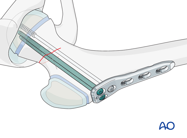 pediatric hip locking plate