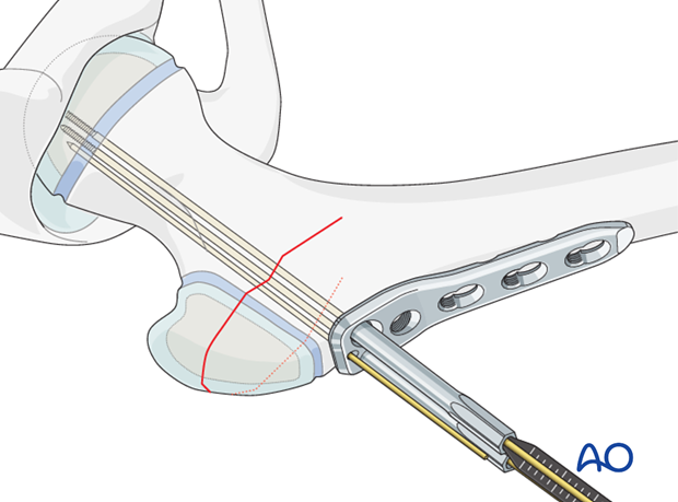 pediatric hip locking plate