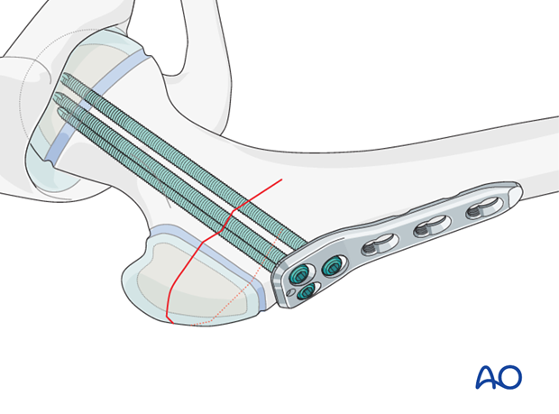 pediatric hip locking plate