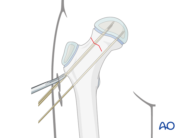 in situ fixation with k wires or screws