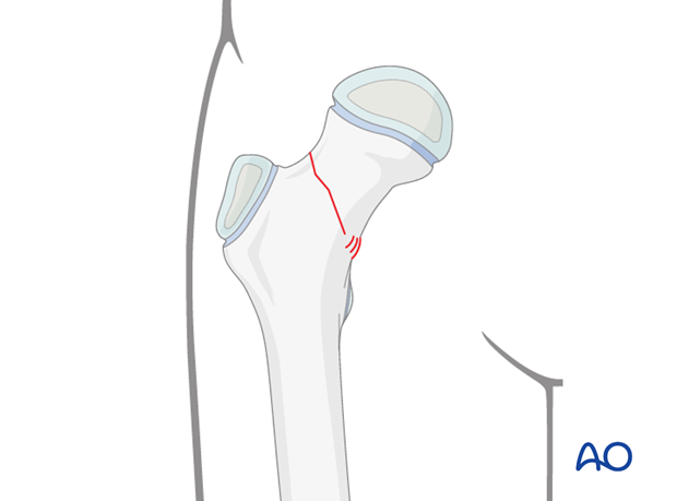 in situ fixation with k wires or screws