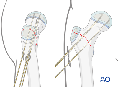 In situ fixation with K-wires or screws for Incomplete transtrochanteric