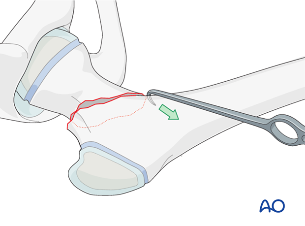 open reduction pediatric hip locking plate