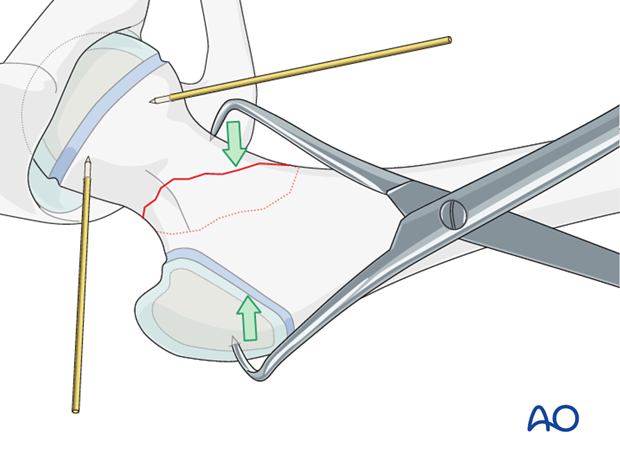 open reduction pediatric hip locking plate