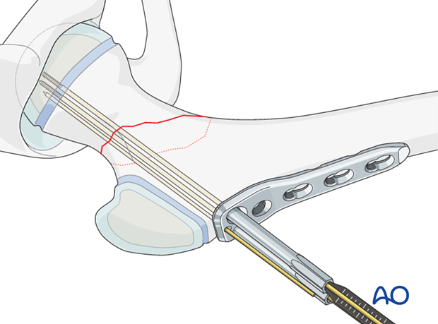 open reduction pediatric hip locking plate