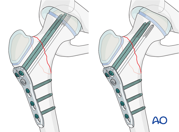 open reduction pediatric hip locking plate