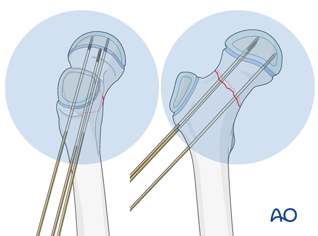 open reduction k wire fixation