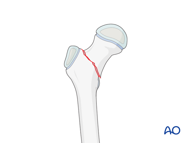 Open reduction, pediatric hip locking plate for 31-M/3.1 II - Complete ...