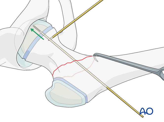 Open reduction, K-wire fixation for Complete basicervical, simple