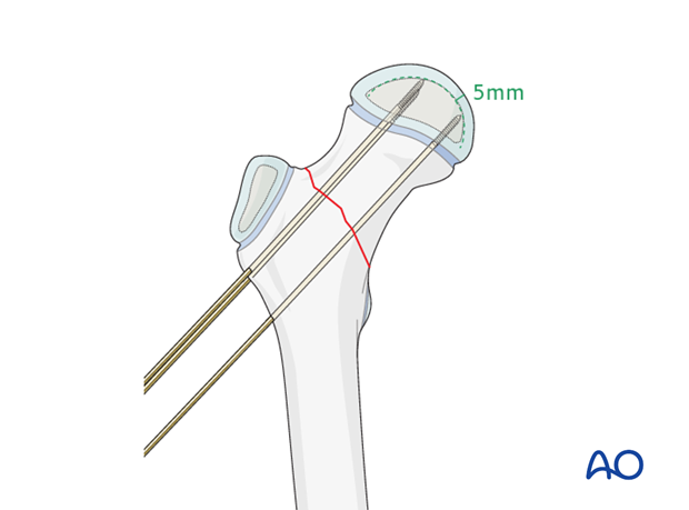 open reduction k wire fixation