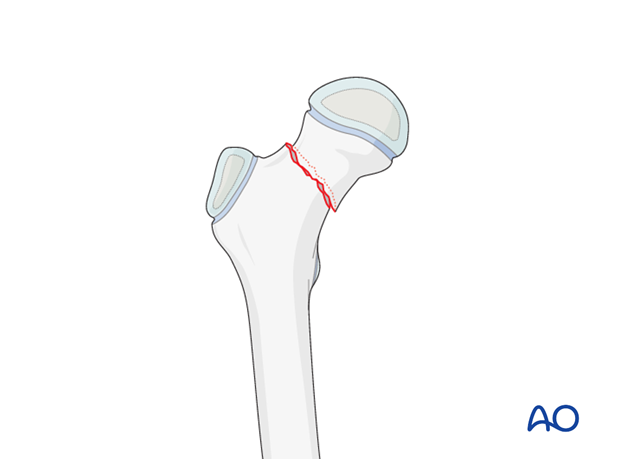 open reduction screw fixation