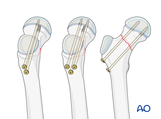 open reduction screw fixation