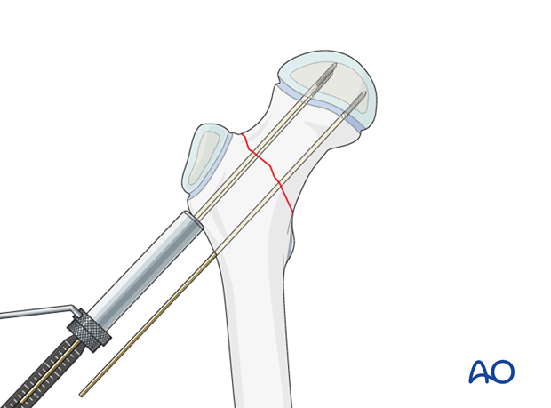 open reduction screw fixation