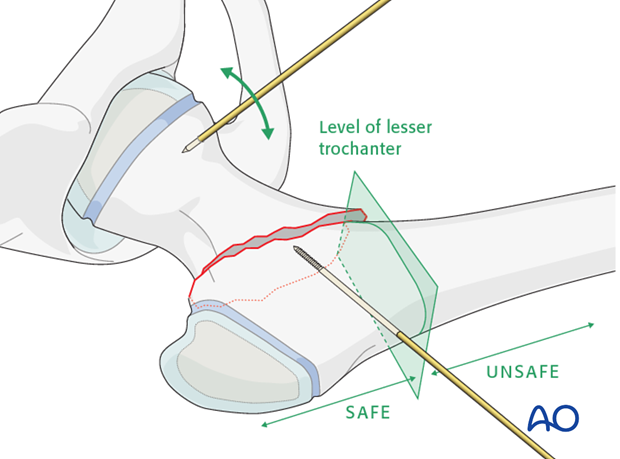 open reduction screw fixation