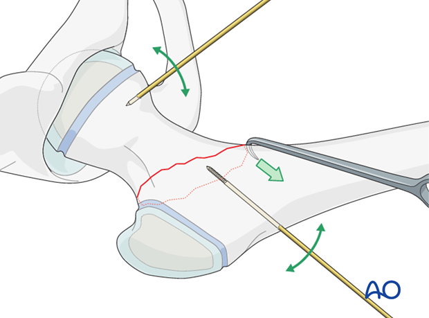 open reduction screw fixation