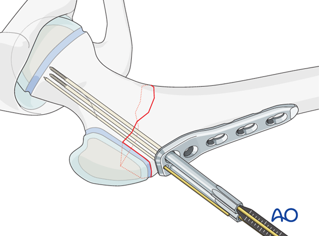 open reduction pediatric hip locking plate