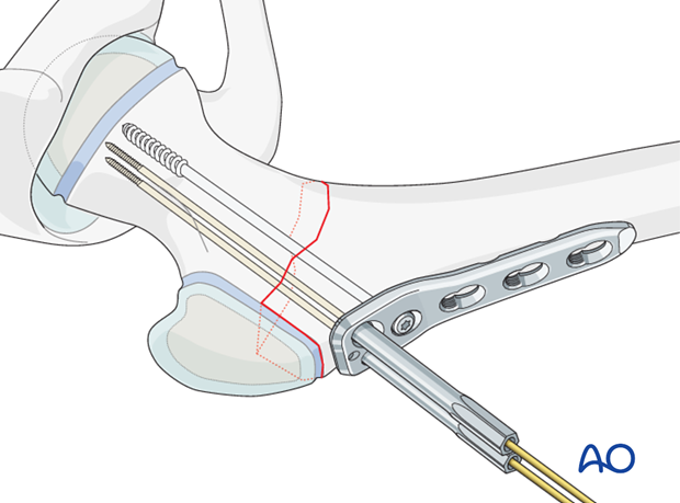 open reduction pediatric hip locking plate