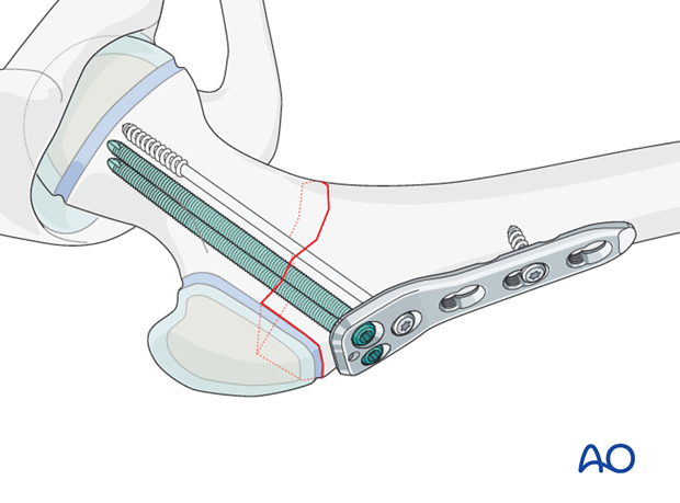 open reduction pediatric hip locking plate