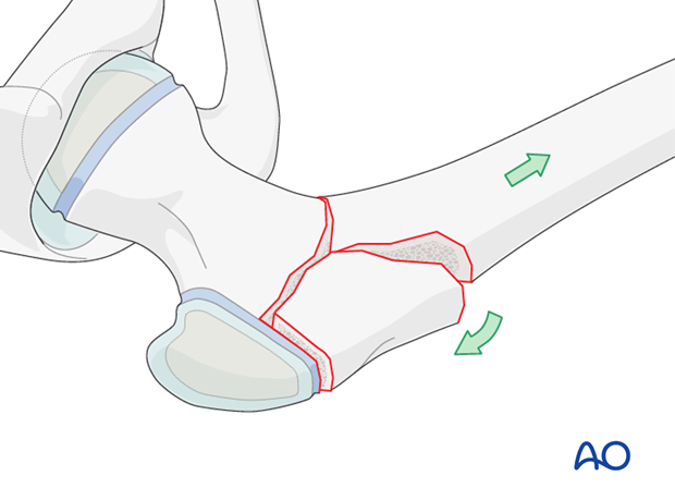 open reduction pediatric hip locking plate