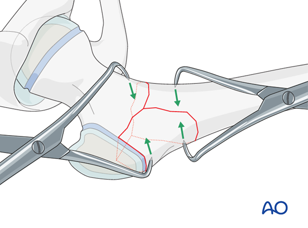 open reduction pediatric hip locking plate