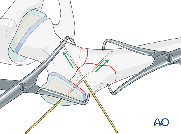 open reduction pediatric hip locking plate